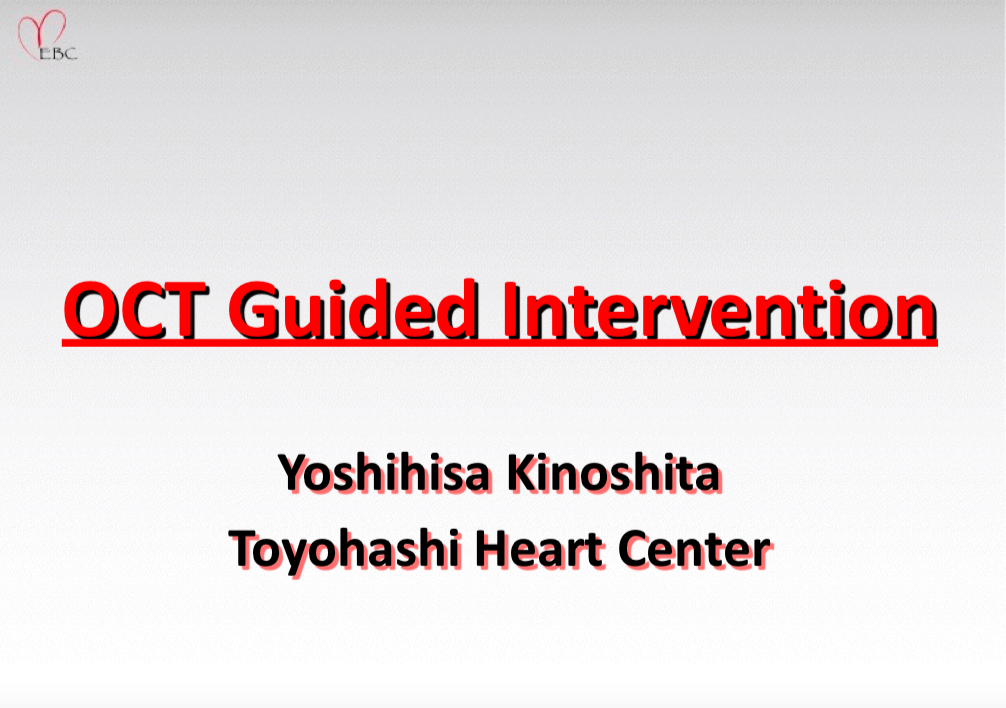 Read more about the article OCT guided intervention