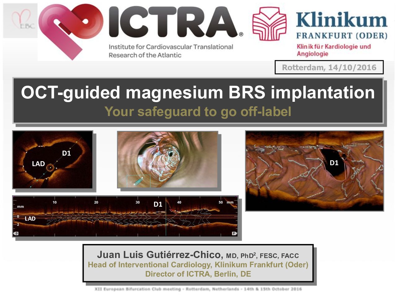 You are currently viewing OCT-guided magnesium BRS implantation