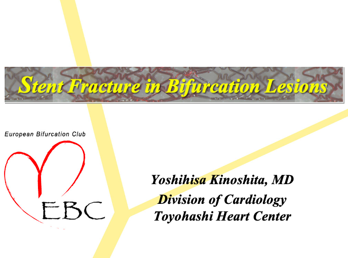 Read more about the article Stent Fracture in Bifurcation Lesions