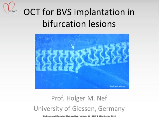You are currently viewing OCT for BVS implantation in bifurcation lesions