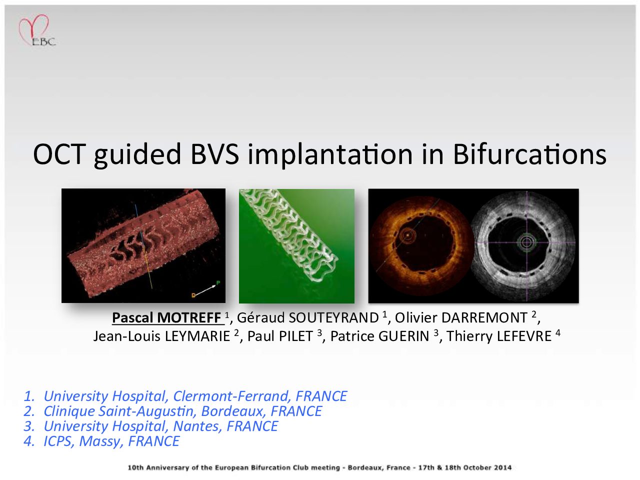 Read more about the article OCT guided BVS Implantation