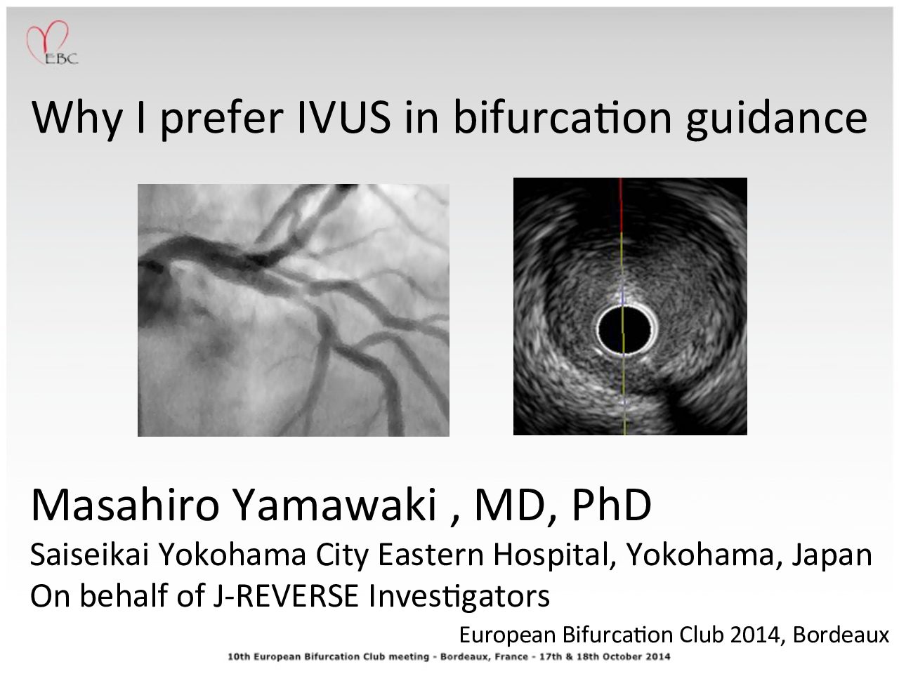 Read more about the article Why I prefer IVUS in bifurcation guidance