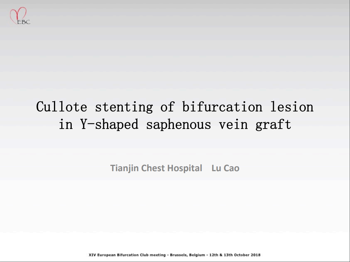 You are currently viewing Culotte stenting in a Y shaped saphenous vein graft bifurcation