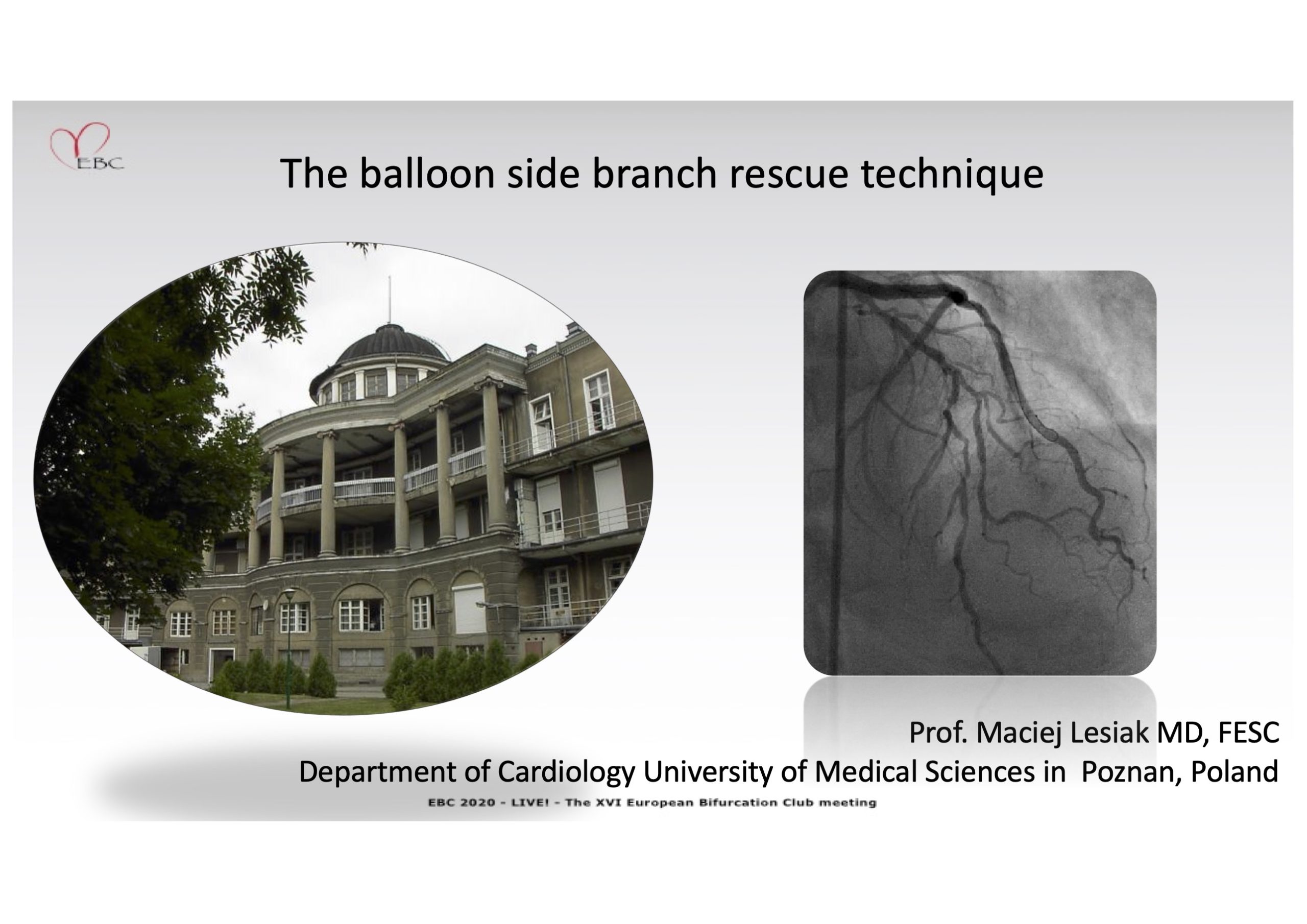 You are currently viewing The balloon side branch rescue technique – Dr Maciej Lesiak